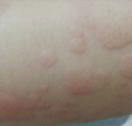 过敏性湿疹重在预防