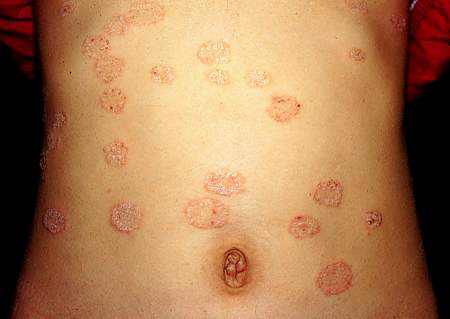 面对股癣的治疗 患者朋友们需要坚持