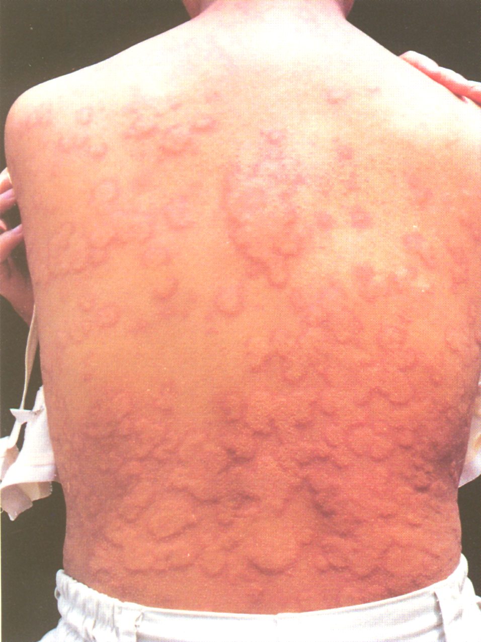 荨麻疹早期症状表现