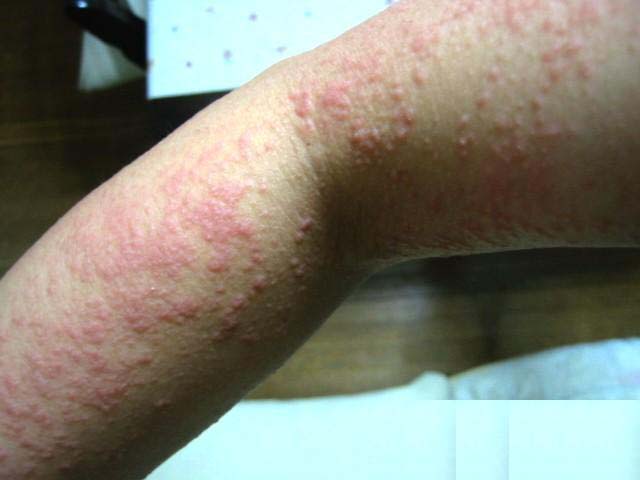 长春皮肤病专家解析急性湿疹治疗途径