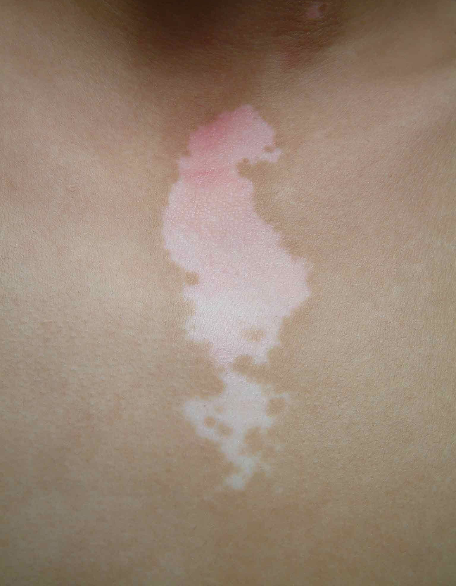 白癜风对于患者的皮肤的有很大的危害