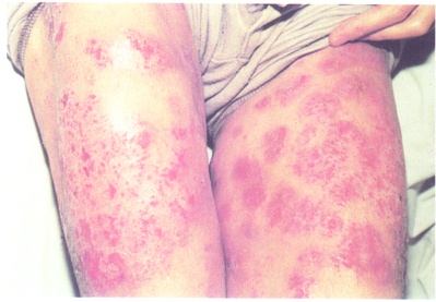 皮炎是指一种皮肤炎症