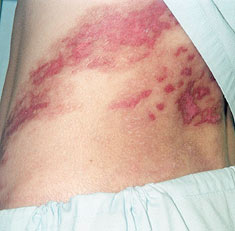 生殖器疱疹的症状有哪些？