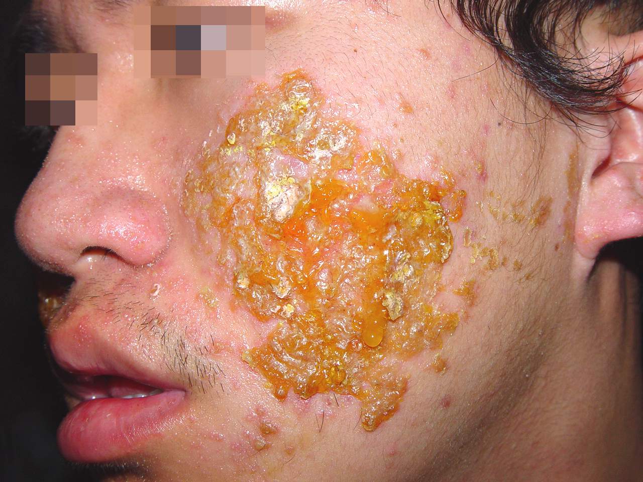 专家告诉你口周皮炎的症状有哪些