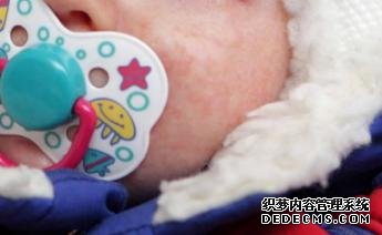 婴儿湿疹的诱因有哪些？ 