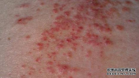 湿疹有哪些诱发因素？